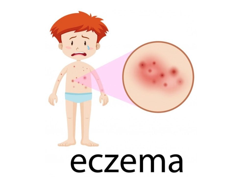 Baby Boy Suffering from Eczema